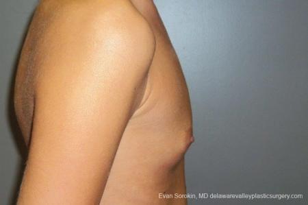 Philadelphia Breast Augmentation 8668 - Before Image 4