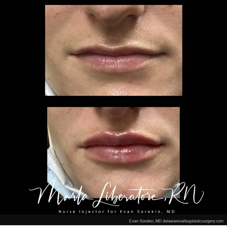 Lip Augmentation: Patient 18 - Before and After Image 1