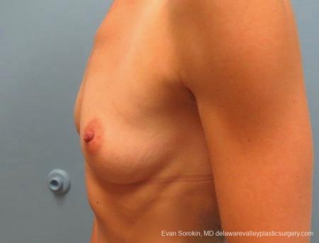 Philadelphia Breast Augmentation 8823 - Before Image 3