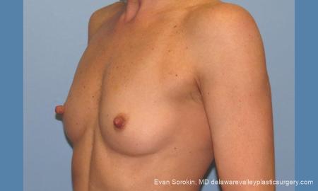 Philadelphia Breast Augmentation 9744 - Before Image 4