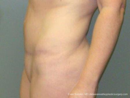 Philadelphia Abdominoplasty 9474 - After Image 5
