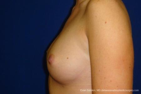 Philadelphia Breast Augmentation 8670 - Before and After Image 5