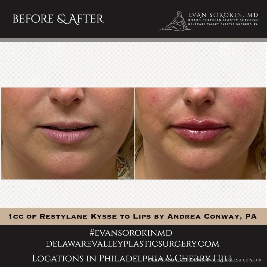 Lip Filler: Patient 43 - Before and After 1