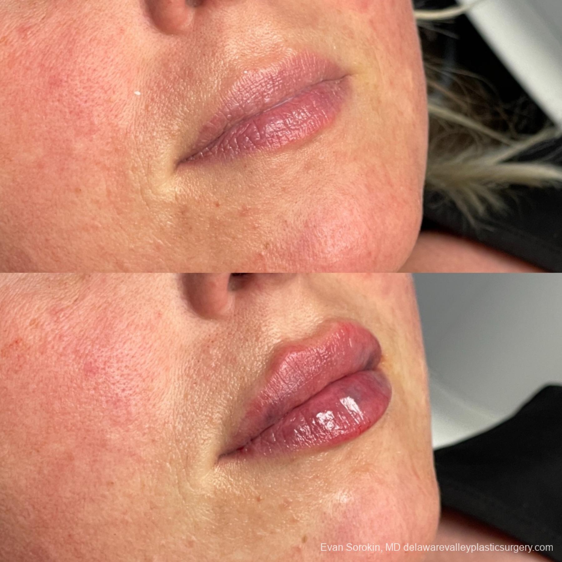 Lip Filler: Patient 67 - Before and After 2