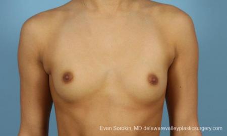 Philadelphia Breast Augmentation 9408 - Before Image 1