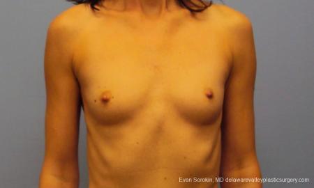 Philadelphia Breast Augmentation 9417 - Before Image 1