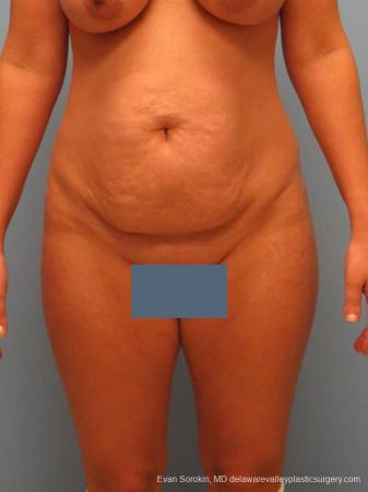 Philadelphia Abdominoplasty 9460 - Before Image 1