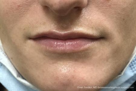 Lip Augmentation: Patient 13 - Before Image 1