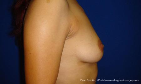 Philadelphia Breast Augmentation 9294 - Before and After Image 5