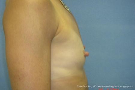 Breast Augmentation 8667 - Before and After Image 3