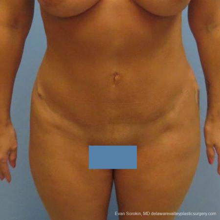 Philadelphia Abdominoplasty 9475 - After Image 1