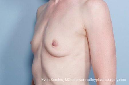 Philadelphia Breast Augmentation 9169 - Before Image 4
