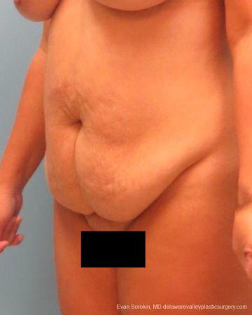 Philadelphia Abdominoplasty 9267 - Before Image 4