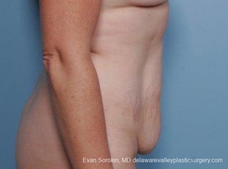 Philadelphia Abdominoplasty 9315 - Before Image 3
