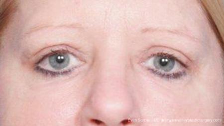 Philadelphia Blepharoplasty 9314 - After Image 1