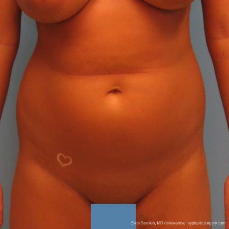 Philadelphia Liposuction 9483 - Before Image 1