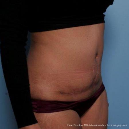 Philadelphia Abdominoplasty 9479 - After Image 2