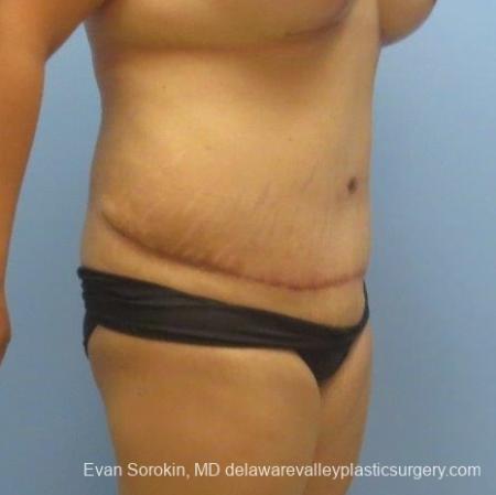 Philadelphia Abdominoplasty 8678 - After Image 2