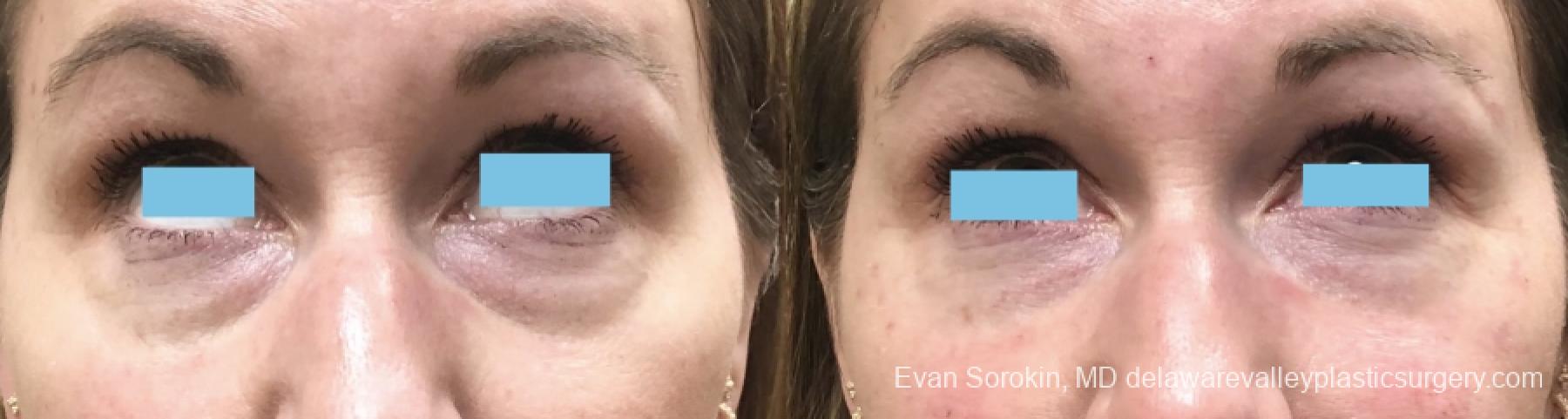 Fillers: Patient 11 - Before and After 