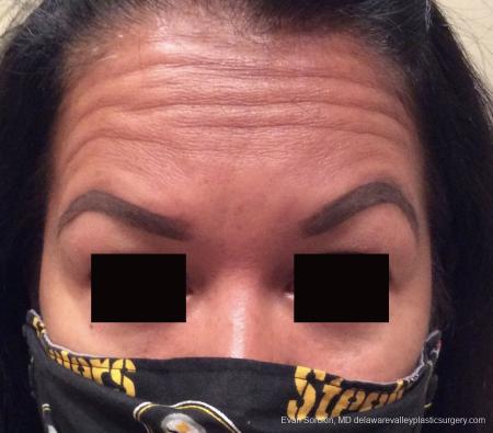 BOTOX® Cosmetic: Patient 1 - Before Image 1