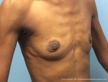 Philadelphia Breast Augmentation 13072 - Before 2