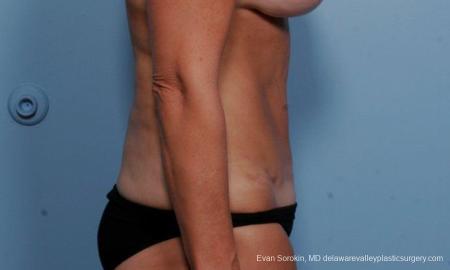 Philadelphia Abdominoplasty 9376 - After Image 3