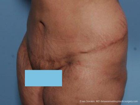 Philadelphia Abdominoplasty 9462 - After Image 4