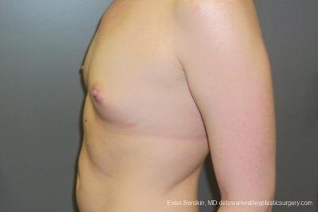 Philadelphia Breast Augmentation 8669 - Before and After Image 5