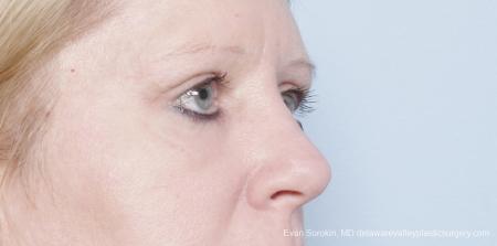 Philadelphia Blepharoplasty 9314 - After Image 2