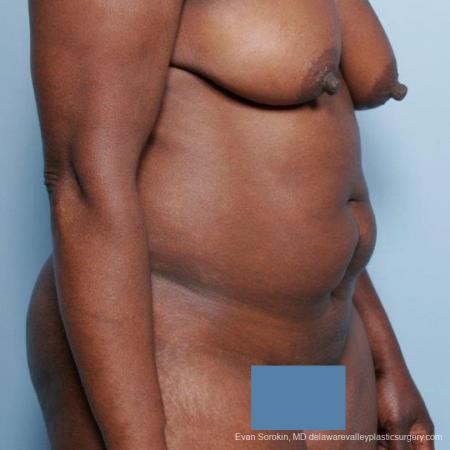 Philadelphia Abdominoplasty 9477 - Before Image 2