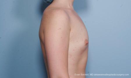 Philadelphia Breast Augmentation 9176 - Before and After Image 5