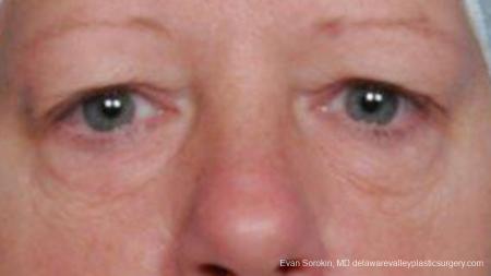 Philadelphia Blepharoplasty 9314 - Before Image 1