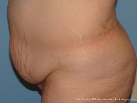 Philadelphia Abdominoplasty 9467 - Before and After Image 5