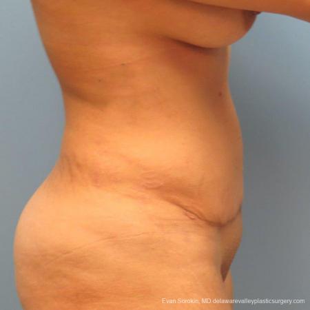 Philadelphia Abdominoplasty 9478 - After Image 5