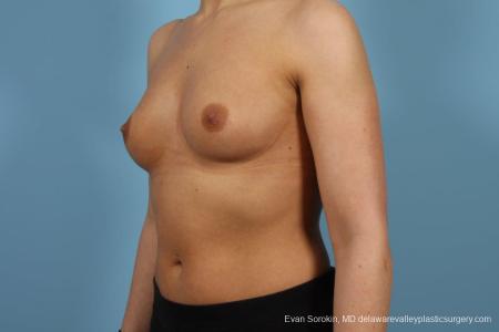Philadelphia Breast Augmentation 8643 - Before Image 4