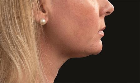 CoolSculpting®: Patient 5 - After Image 1