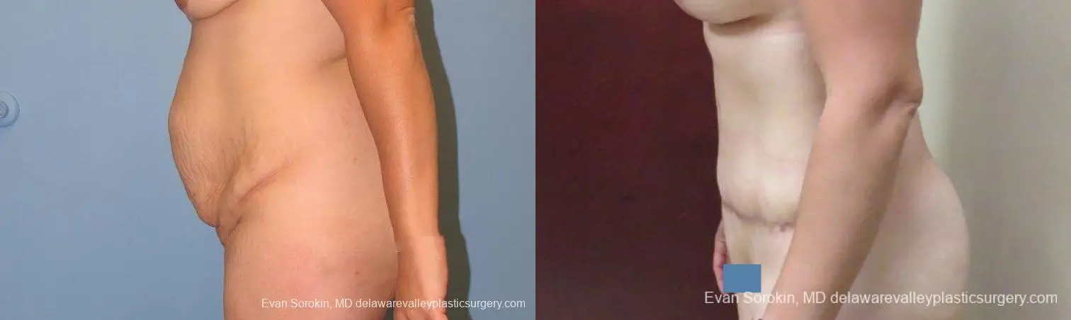 Philadelphia Abdominoplasty 10122 - Before and After 5