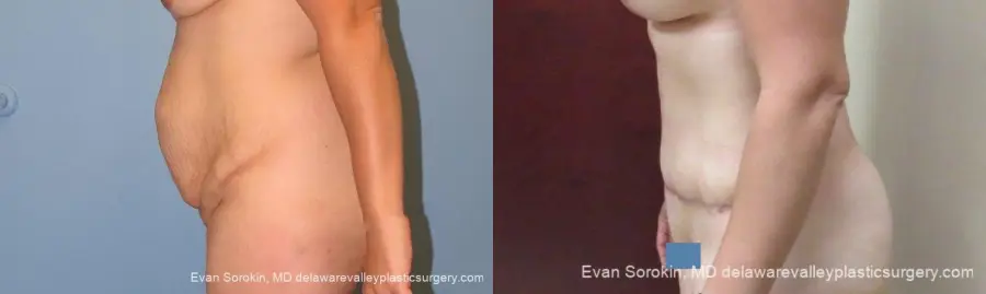 Philadelphia Abdominoplasty 10122 - Before and After 5
