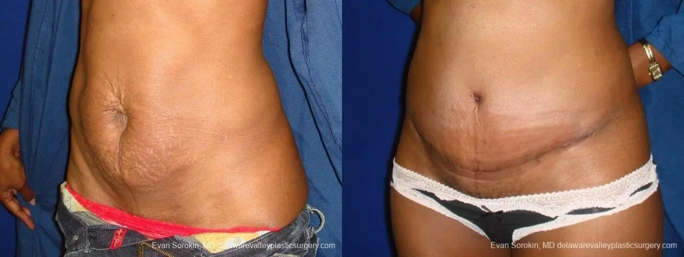 Philadelphia Abdominoplasty 8707 - Before and After 2