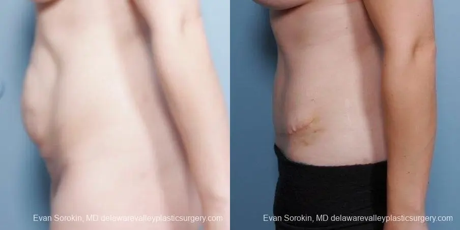 Philadelphia Abdominoplasty 8681 - Before and After 5