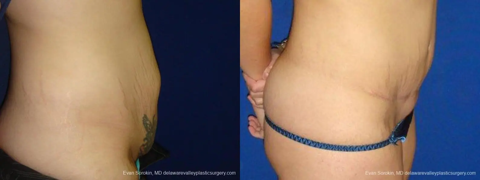 Philadelphia Abdominoplasty 9473 - Before and After 3