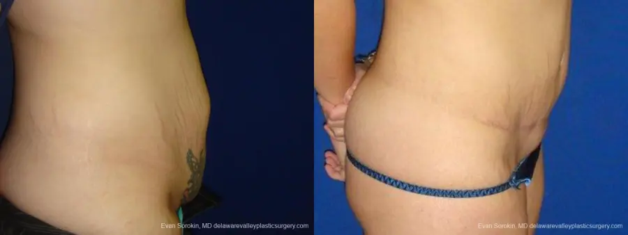 Philadelphia Abdominoplasty 9473 - Before and After 3