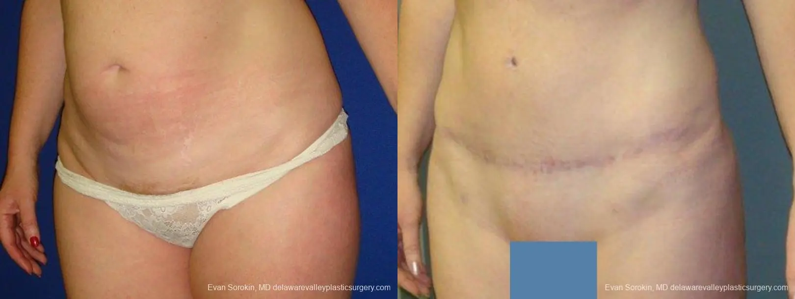 Philadelphia Abdominoplasty 9474 - Before and After 4