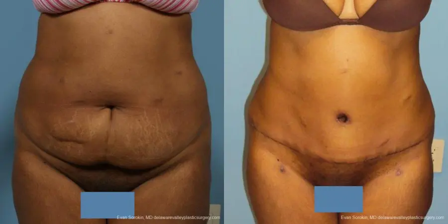 Philadelphia Abdominoplasty 9472 - Before and After 1
