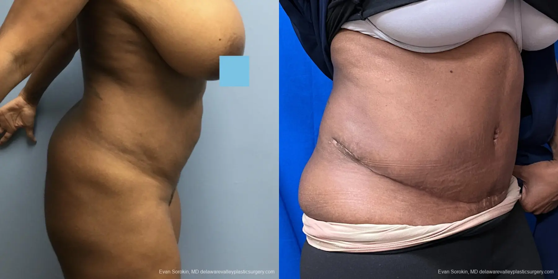 Abdominoplasty: Patient 39 - Before and After 3