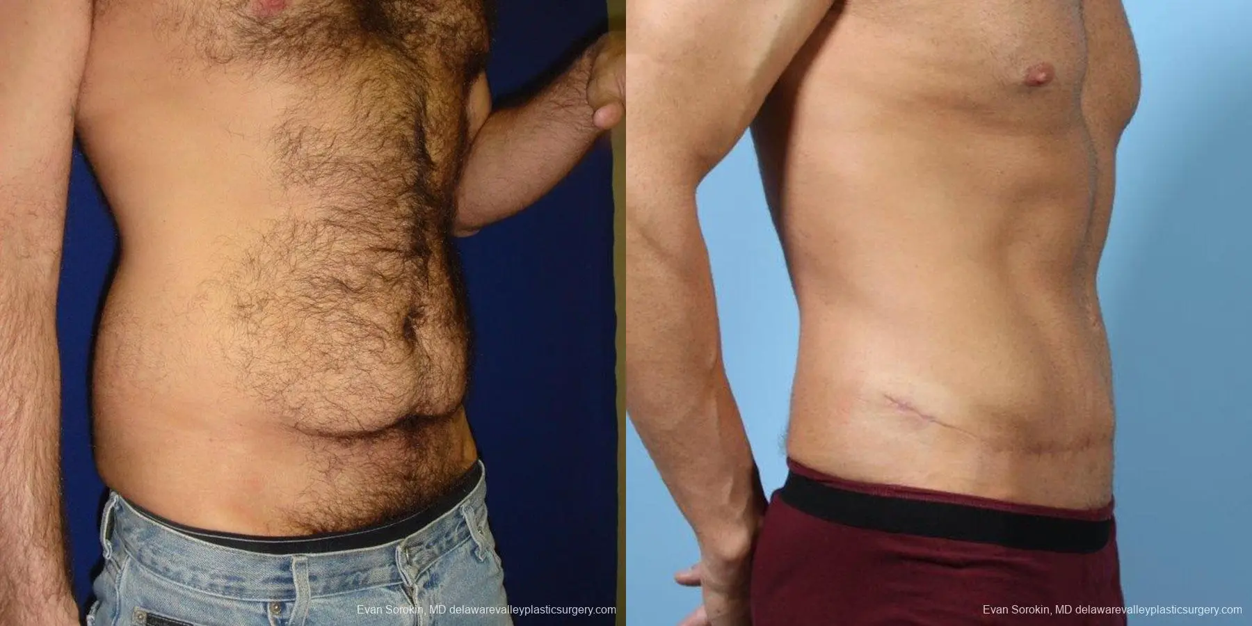 Philadelphia Abdominoplasty 9468 - Before and After 2