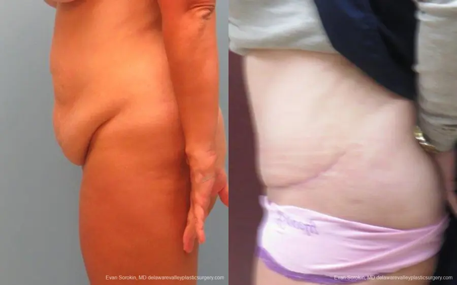 Philadelphia Abdominoplasty 9267 - Before and After 5