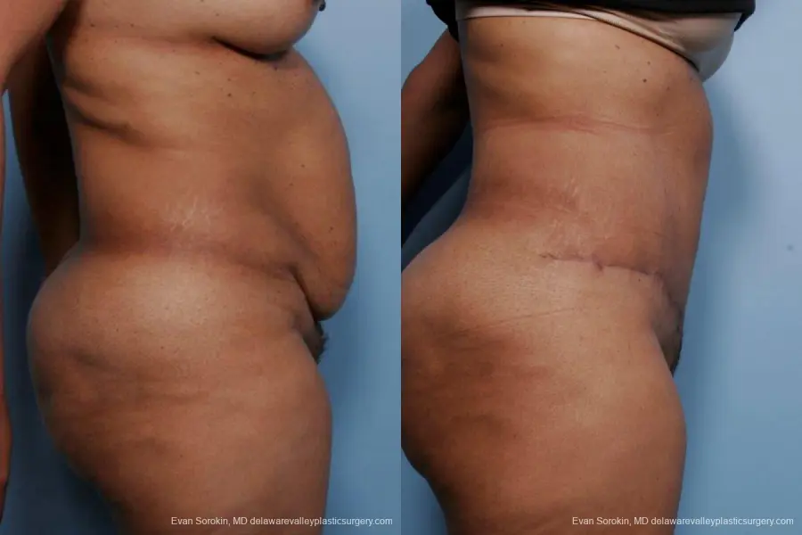 Philadelphia Abdominoplasty 9461 - Before and After 3