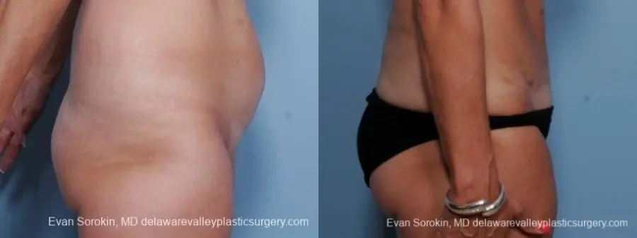 Philadelphia Abdominoplasty 8682 - Before and After 4