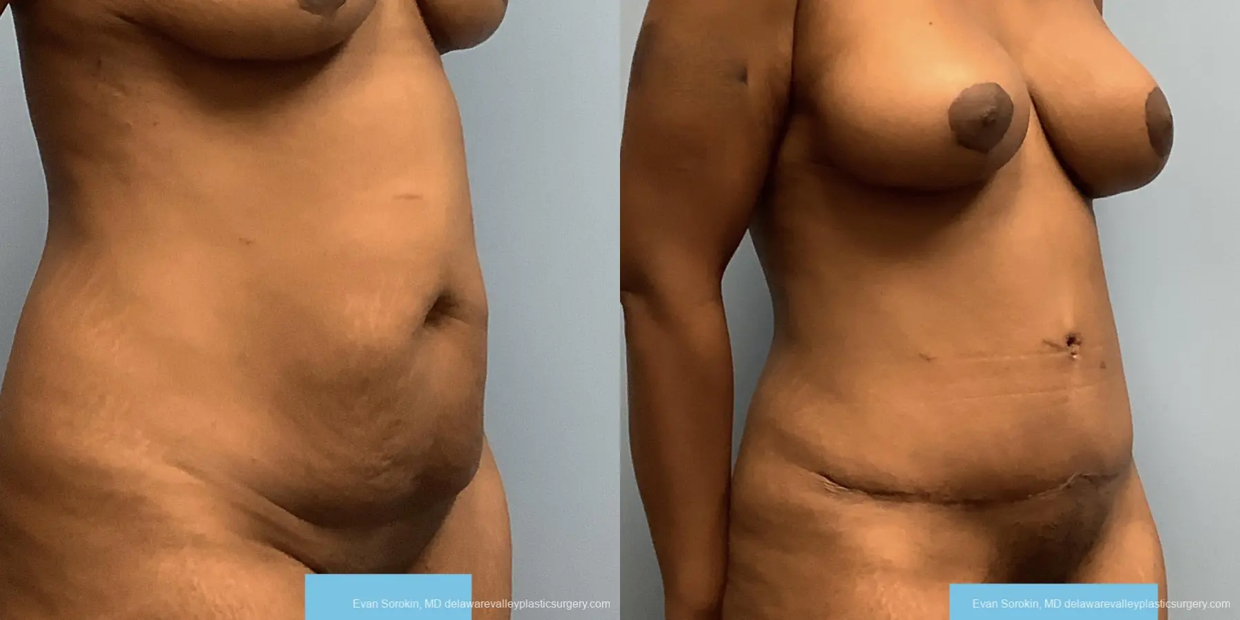Abdominoplasty: Patient 33 - Before and After 2